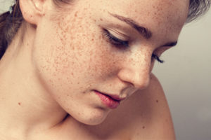 Difference between Freckles and Moles