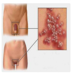 Difference between ingrown hair and genital warts