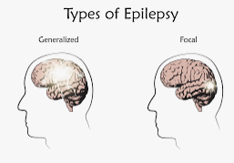 Types of Epilepsy